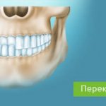 correction of mesial bite