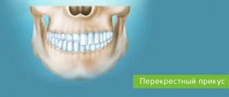 исправление мезиального прикуса