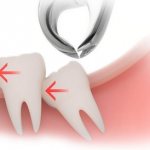 Wisdom tooth extraction