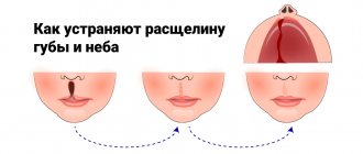 How to fix cleft lip and palate