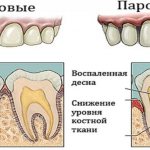 Как выглядит пародонтоз