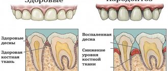 Как выглядит пародонтоз