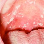 Oral candidiasis