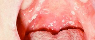 Oral candidiasis