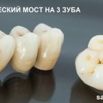 Ceramic dental bridge