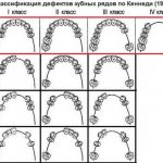 Classification of dentition defects according to Kennedy. Orthopedics 