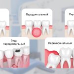 Collage of tooth abscess options