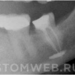 Composite materials in dentistry: chemical, light, fluid, micro-filled