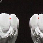 contact area between teeth