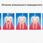 Лечение апикального периодонтита зуба в картинках