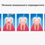 Treatment of apical periodontitis of the tooth in pictures