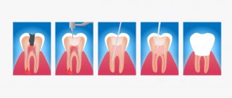 Treatment of apical periodontitis of the tooth in pictures