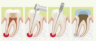 Лечение гранулемы зуба