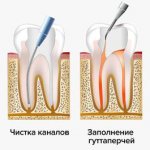 Treatment of periodontitis