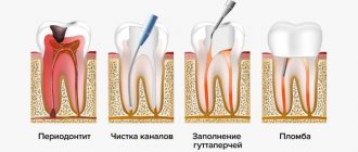 Лечение периодонтита