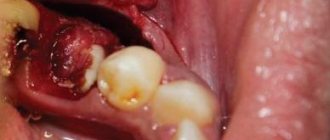 Treatment of complex mixed odontoma