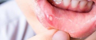 Treatment of stomatitis in children