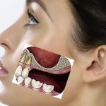 Лучший Кандидат На Имплантацию Зубной Кости