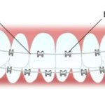 The mechanism of action of the bracket system