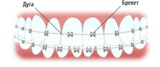 The mechanism of action of the bracket system