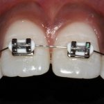 Metal braces