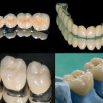 Metal-ceramic crowns