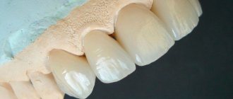 Metal-ceramic crowns