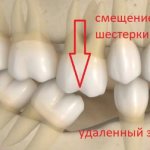 Методы коррекции феномена Попова Годона