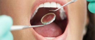 dental bridges