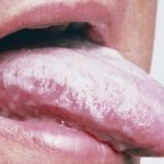 Plaque on the tongue can indicate a lot of different diseases.