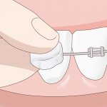 Ортодонтический воск