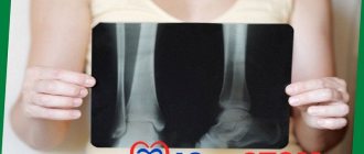 Osteoporosis - detection on x-rays