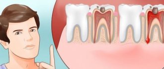 Acute toothache. What to do if your tooth hurts 