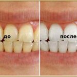 whitening with foil: before and after