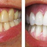 Opalescence whitening before and after photos