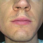 Facial swelling - Smile Line Dentistry