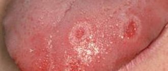 papules on the tongue