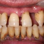 severe periodontitis