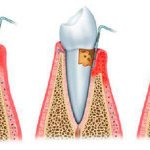 periodontal disease