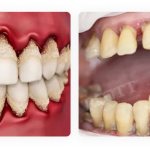 periodontal disease