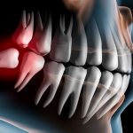 Movement of teeth due to pathologies