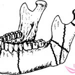 перелом нижней челюсти виды