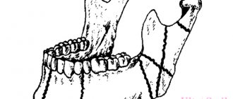 types of mandibular fracture