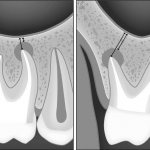 Perforation of the maxillary sinus