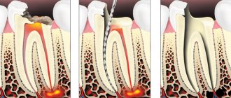 Periodontitis treatment