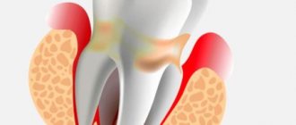 periodontitis