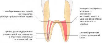 пломбирование корневого канала сочетанием метода серебрения и резорцин-формалинового метода