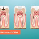 Filling teeth for caries without removing the nerve in pictures