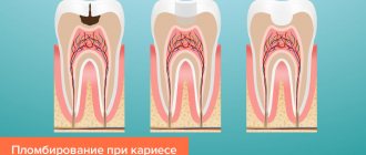 Filling teeth for caries without removing the nerve in pictures