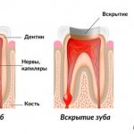 Preparing a tooth for filling